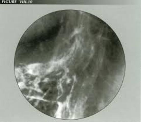 Primer envío de señal fluoroscópica