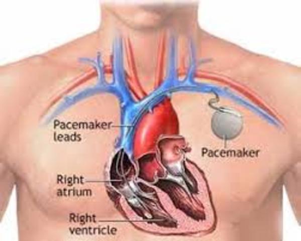 The Implantable Heart Pacemaker