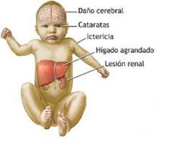 Galactosemia