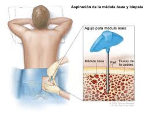 AMILOIDOSIS PRIMARIA AL