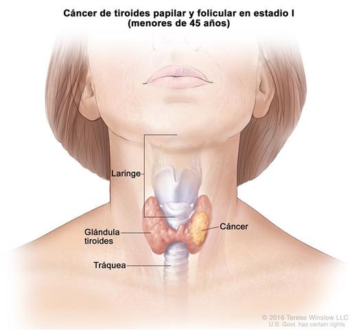 CÁNCER DE TIROIDES