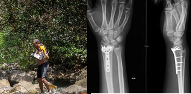 Me fracturo la muñeca izquierda