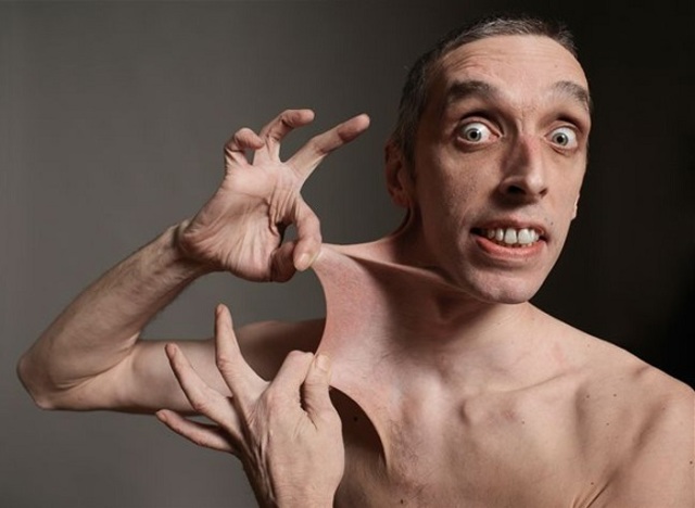 SINDROME DE EHLERS-DANLOS