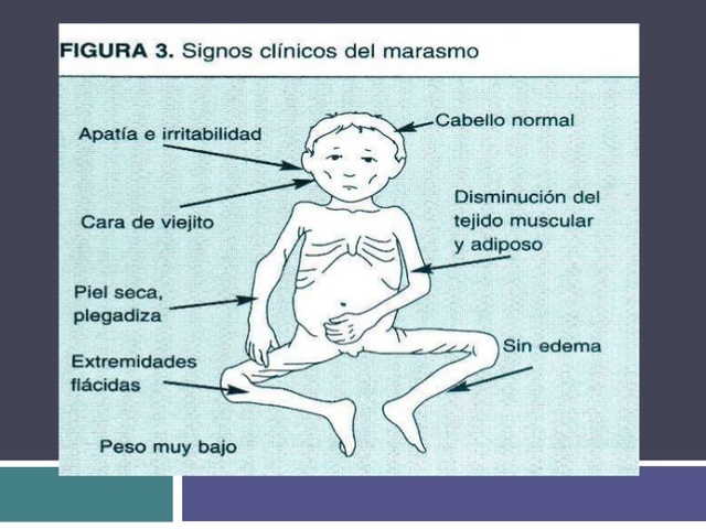 Malnutricion roteico-energetica