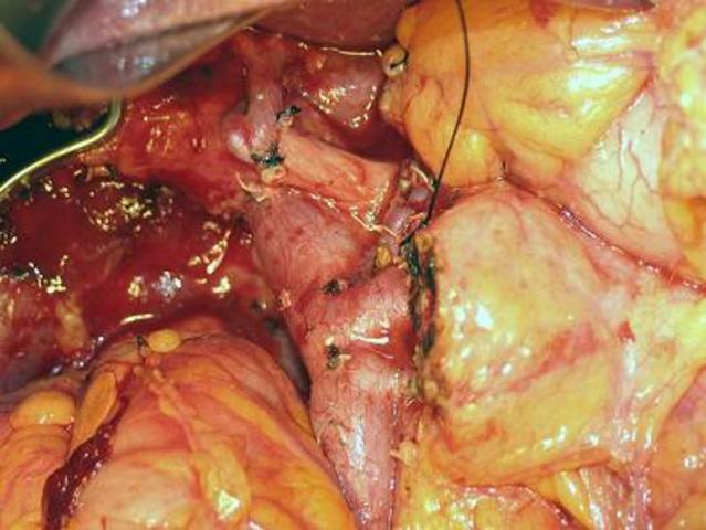 Tasas de supervivencia para los tumores pancreáticos (tratados con cirugía)