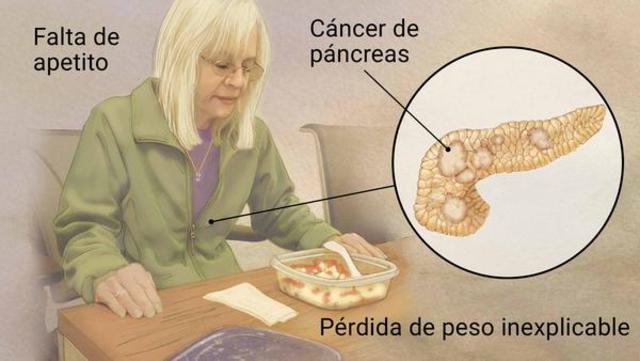 El cáncer de páncreas es el mas mortal y misterioso.
