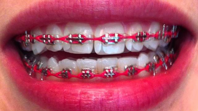 Got Braces