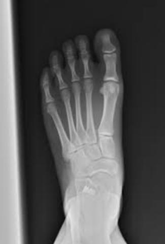 Papà ha schiacciato il piede a Martina