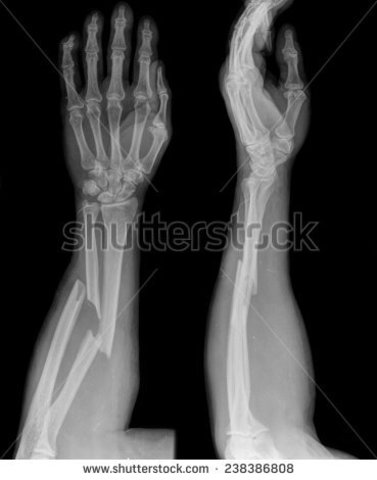 I broke my arm for the first time