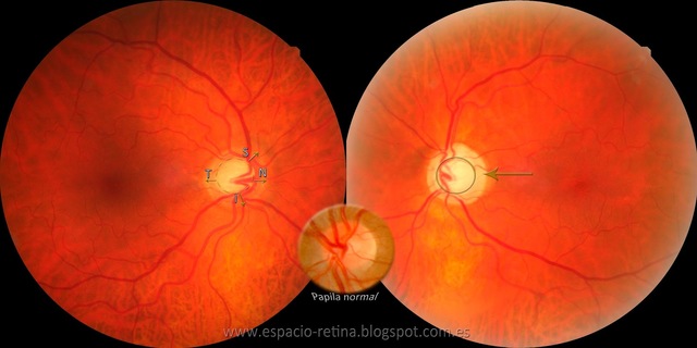 6° Semana - Excavación papilar.