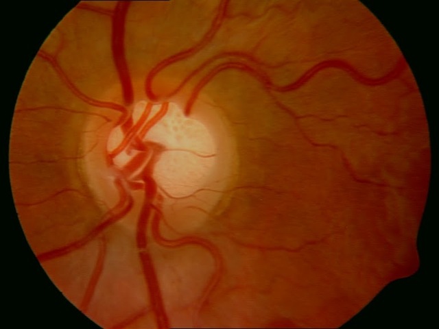5° Semana - Capa externa de la excavación papilar