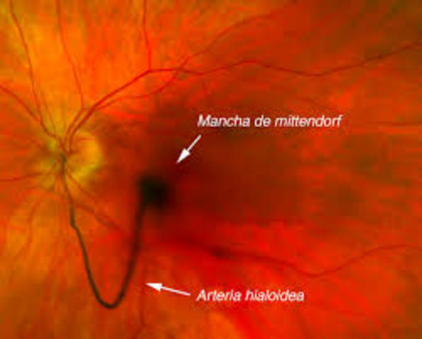 4° Mes - Arteria hialoidea