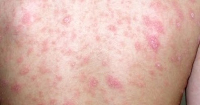 Identificación de moléculas T CD4+.