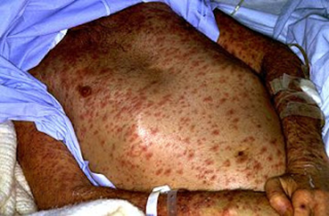 Carcterizacion de pacientes infectados de VIH.