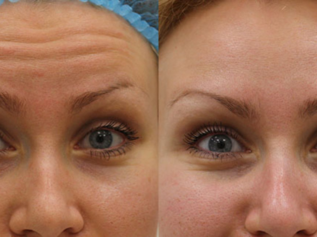 Botulinum toxin (Botox®) application in cosmetology