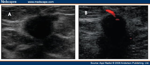 Ultrasound/Mammogram/Biopsy