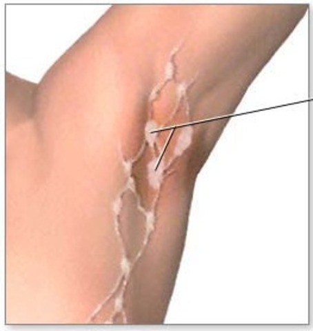 Lymph Node Involvement