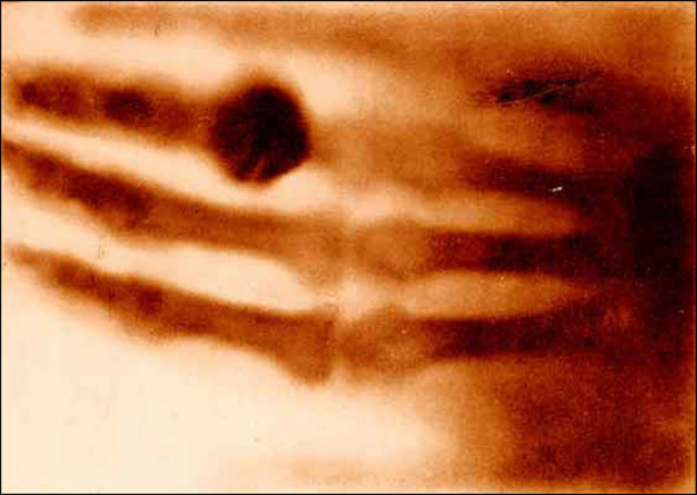 A primeira fotografia raio-X