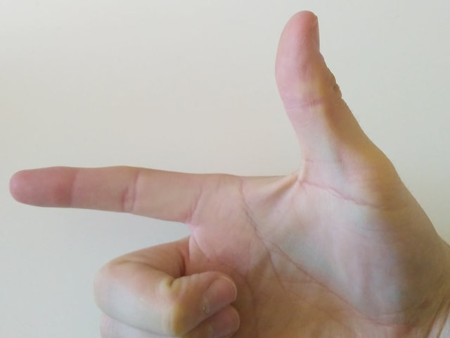 Operació al dit gros