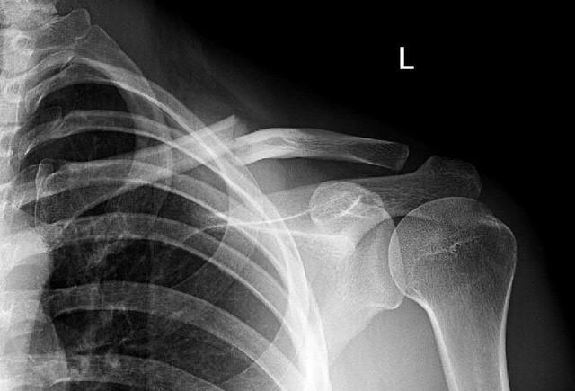 EM TRENCO LA CLAVÍCULA ESQUIANT