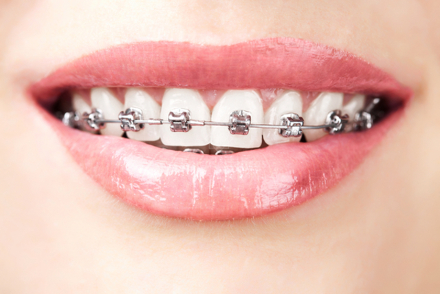 brakets