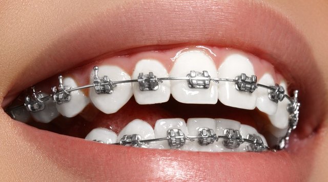 Brackets