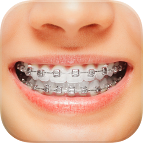 Braces