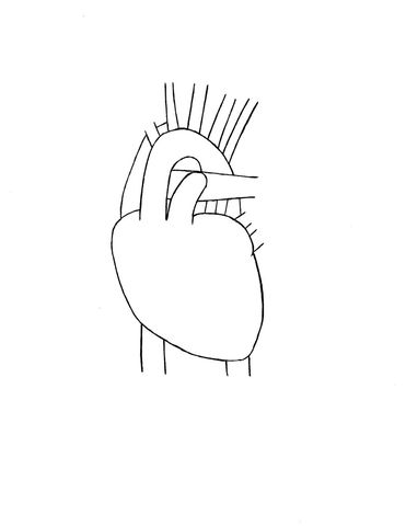 Heart attack, open heart surgery