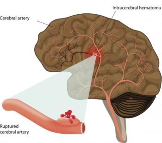 Cerebral Hemorrhage