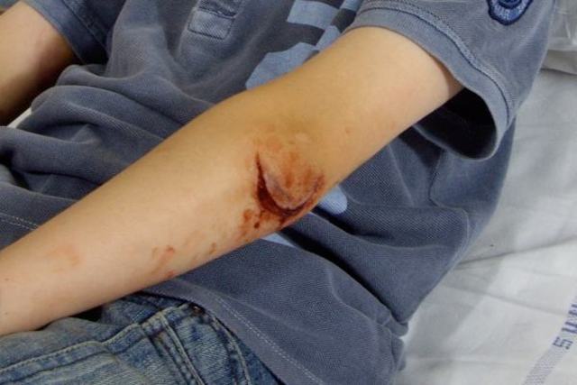 I cut my elbow