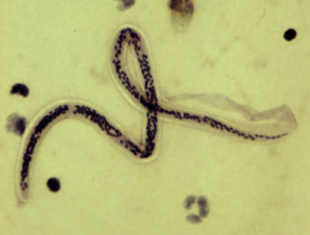 Filariasis linfática