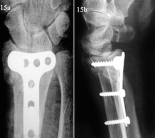 Placas oseas de metal