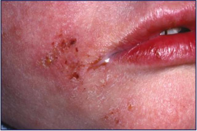 staphylococcus aureus