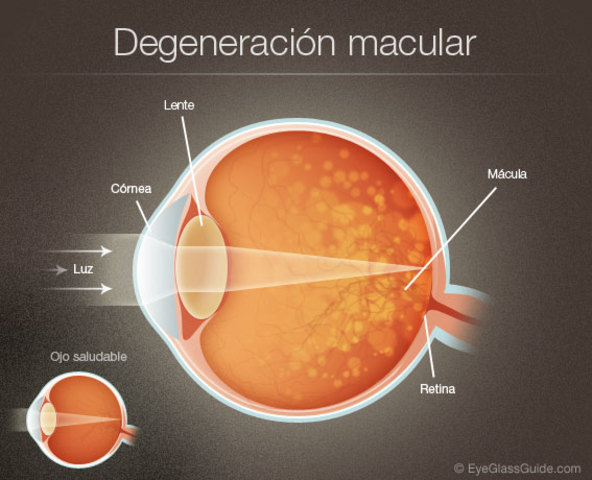 Degeneración macular
