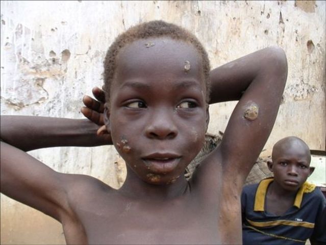 Lucha contra el pian