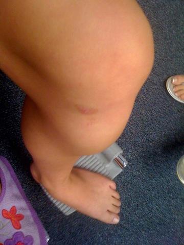 I Fractured My Tibia