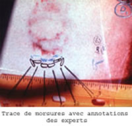 Bite mark evidence