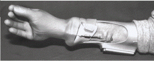 Prótesis activadas por los músculos