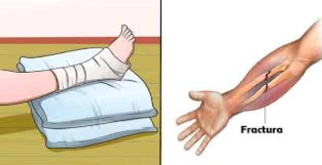 Mi primera fractura