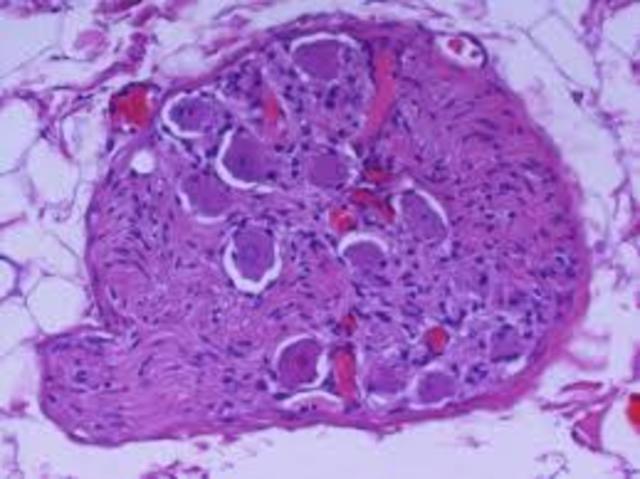 Surgimiento de glangios