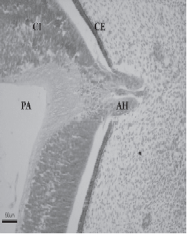 Arteria hialoidea en hendidura embrionaria