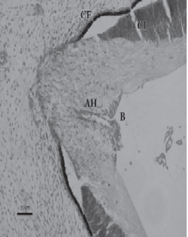 Limitante de glioblastos en trayecto intravitreo de la arteria hialoidea