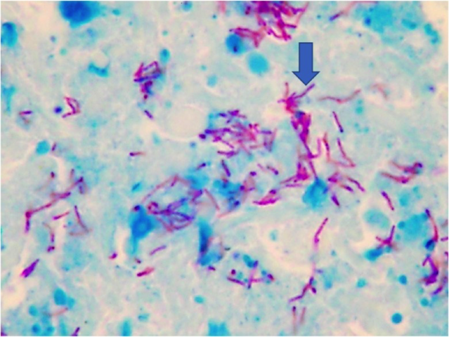 Tinción ácido-alcohol resistente