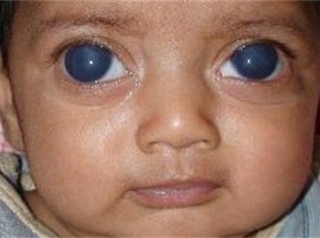 PATOLOGÍA     GLAUCOMA CONGÉNITO