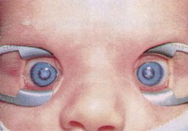 PATOLOGIA   CATARATA CONGENITA