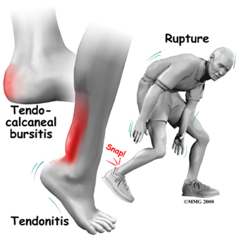 Achilles Tendonitis