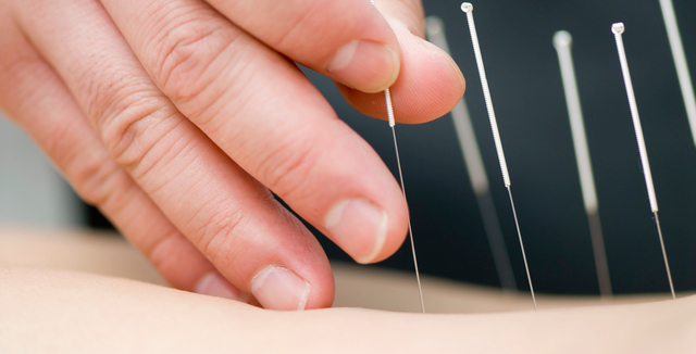 acupuncture