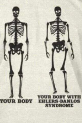 Diagnostico Síndrome de Ehlers Danlos