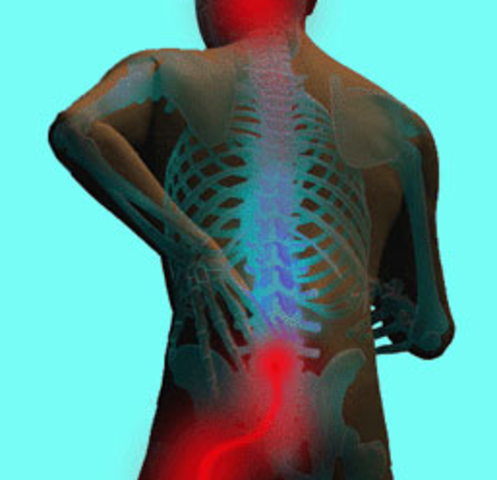 Lumbar herniated disc