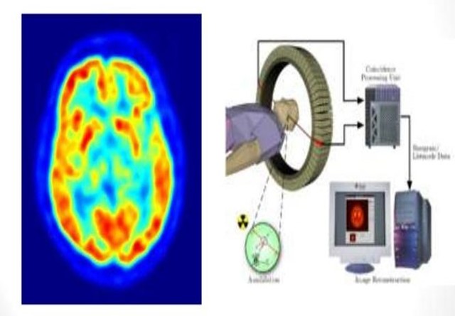 Tomografía por Emisión de Positrones (PET)
